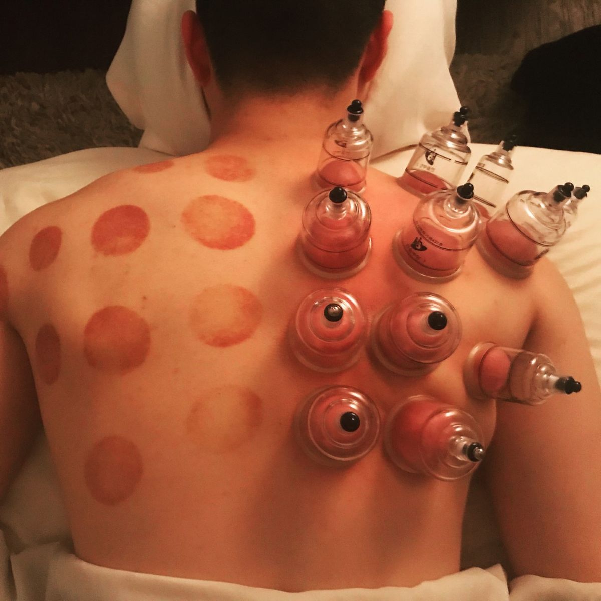Cupping Therapy